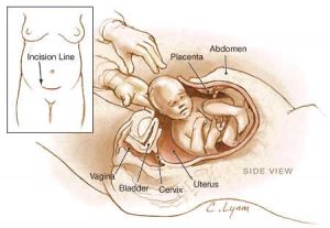 Shubh muhurat for cesarean delivery